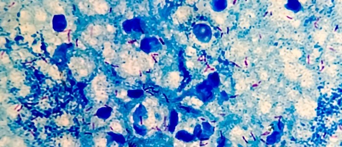 Image of the microbacterium tuberculosis under the microscopr